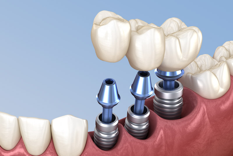 three single dental implants and posts.
