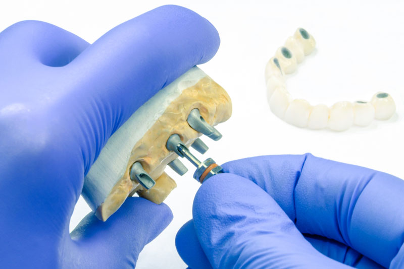 dental implants being custom made by a dentist.