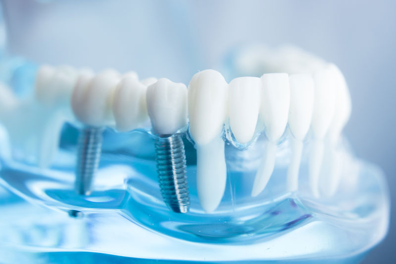 a dental implant model showing a fixed bridge.