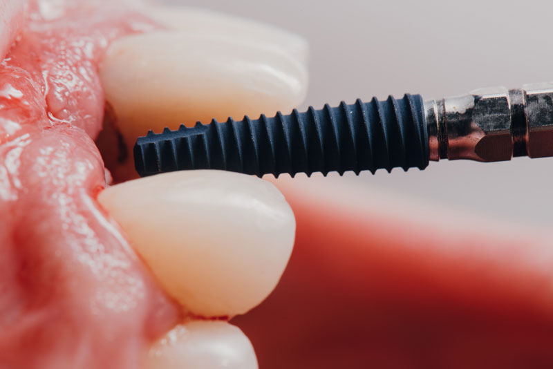 a single dental implant post being placed into a jaw.