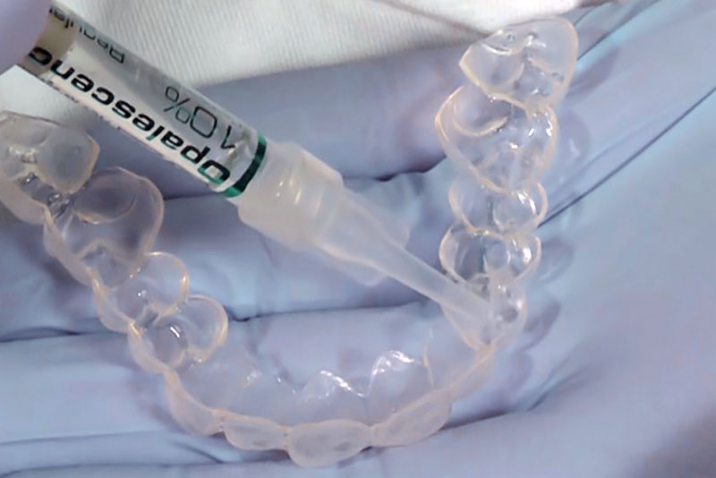 teeth whitening solution being put into dental teeth whitening trays.